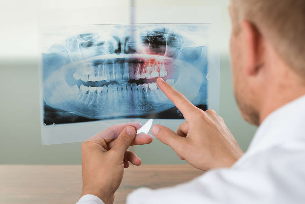 La generación ósea en los dientes